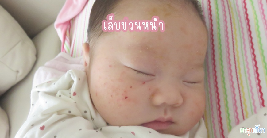 เล็บข่วนหน้า เล็บข่วนหน้า
